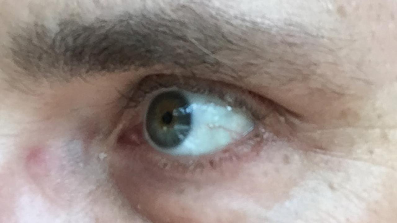 Eye